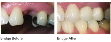 bridges before and after results
