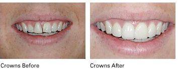 crowns before and after results