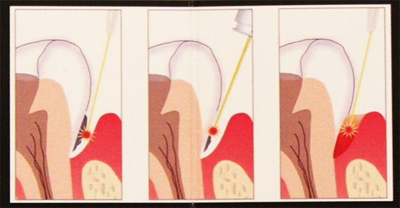laser periodontal gum treatment illustration
