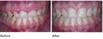 laser periodontal gum treatments before and after results