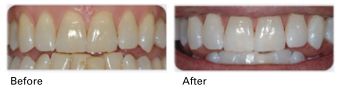 teeth whitening before and after results