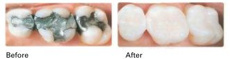 Tooth-colored Cosmetic Fillings before and after results