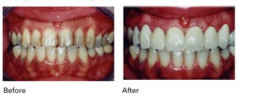 Cosmetic Crowns before and after results