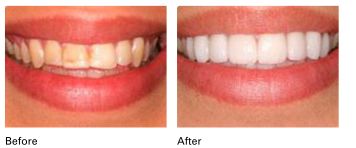 Porcelain Veneers before and after results