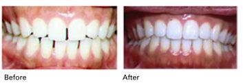 Invisalign (invisable braces) before and after results