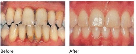 periodontal gum therapy before and after results