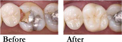 Zirconia Crowns and Bridges before and after results