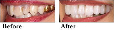 Zirconia Crowns before and after results