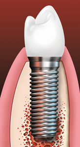 Anatomy_Implant