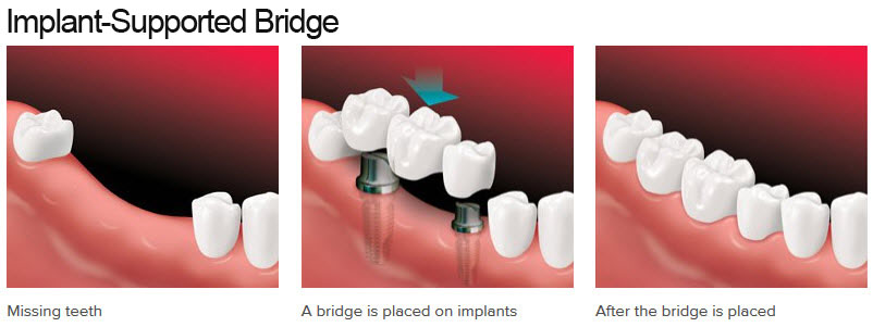 Implant-Supported Bridges before and after results
