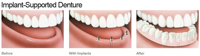 Implant-Supported Dentures before and after results