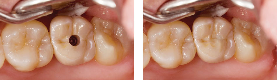 Screw Retained Implants before and after results